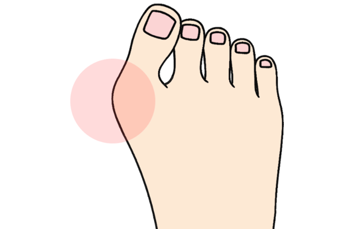 親指が「く」の字に変形