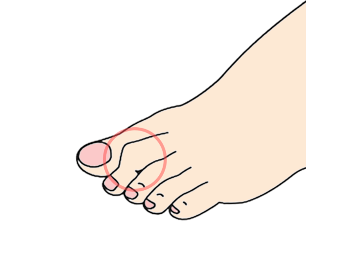 ゆびが重なったり、ハンマーのような形に